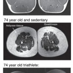 MRI images of the quadricep (athlete vs. sedentary individual)